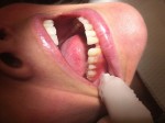 Notice the Gap in this Patient's Smile. 